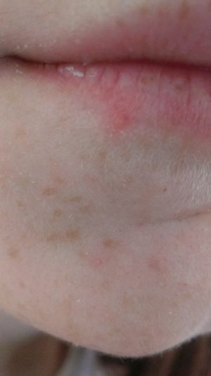 Cold Sore Or Pimple General Acne Discussion